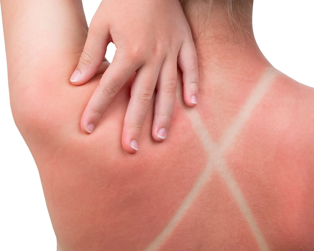 Best Practices For Preventing Sunburn preventing sunburn